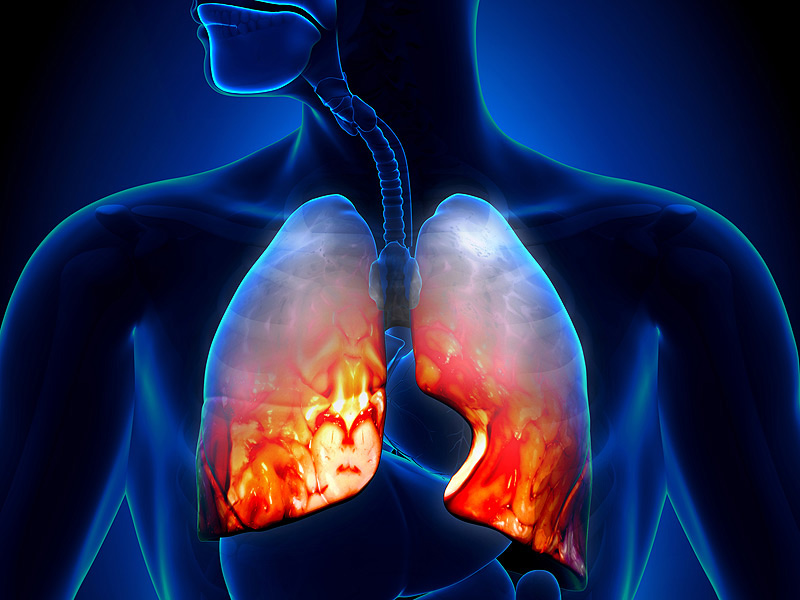 Pneumonia โรคปอดบวมเป็นง่ายเมื่อเข้าหน้าหนาวในแต่ละปี