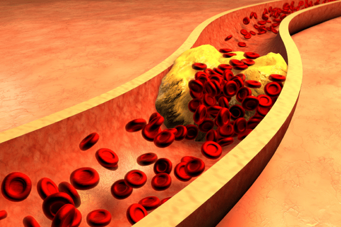 ภาวะไขมันในเลือดสูง (Hyperlipidemia) ภาวะคอเลสเตอรอลในเลือดสูง